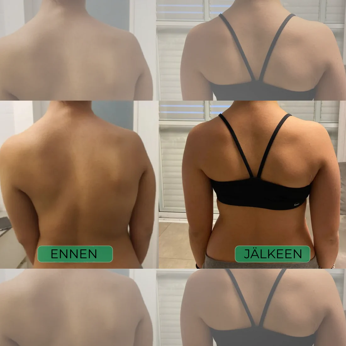 Uprighta™ | Instant Posture Corrector -asennonkorjain