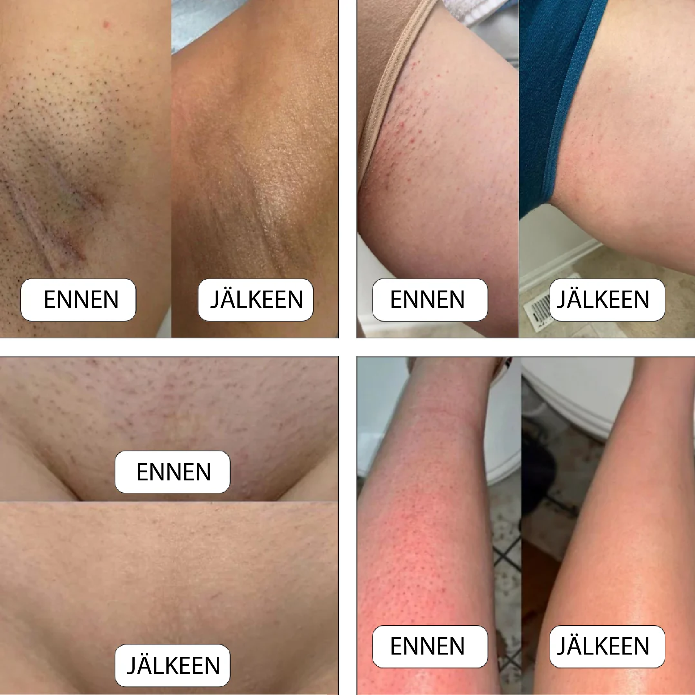 #Solys® SmoothShave Ihokarvanpoistaja