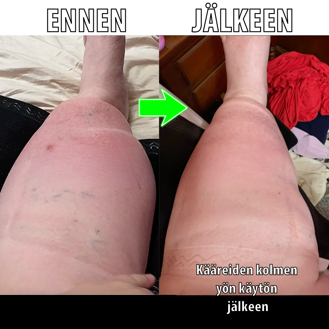 Säärikompressiokääre